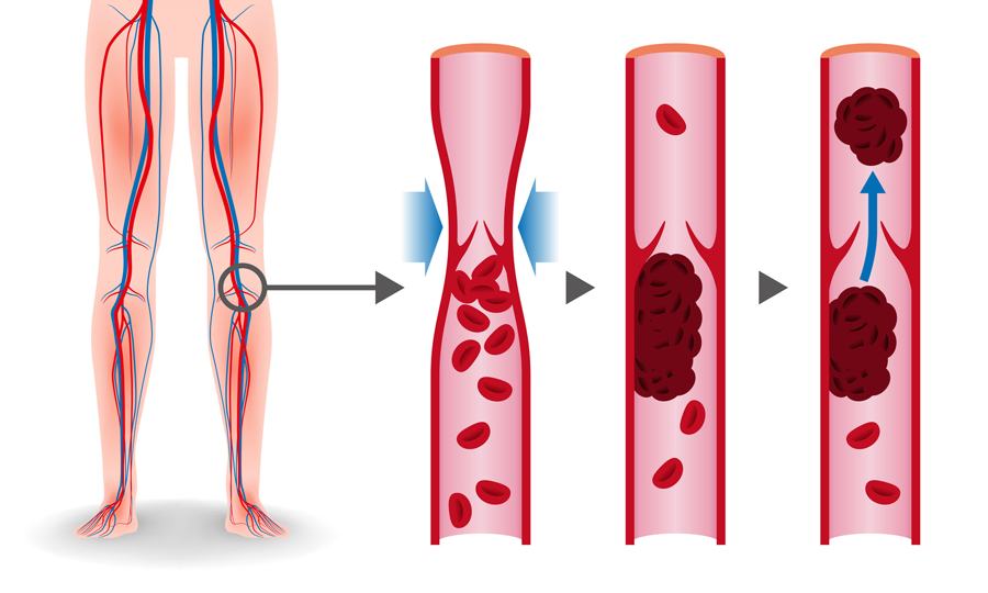 脚の静脈にできた血栓が肺の動脈を塞ぎ、働きを妨げる